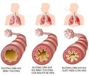 bệnh hen suyễn phổ biến