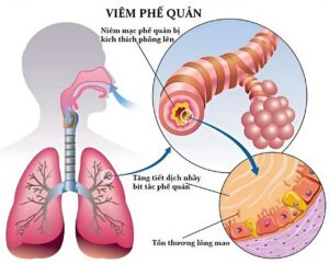 chuẩn đoán bệnh hen suyễn