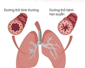 nguyên nhân gây ra bệnh hen suyễn