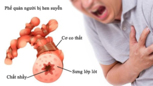 bệnh hen suyễn sống được bao lâu