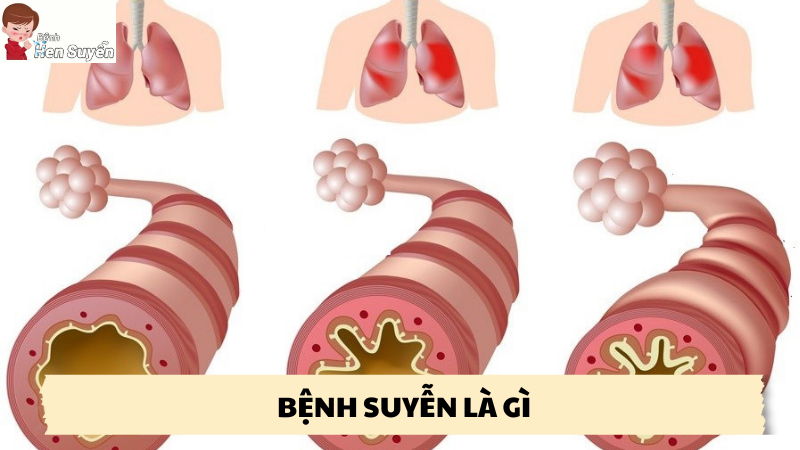 bệnh suyễn là gì