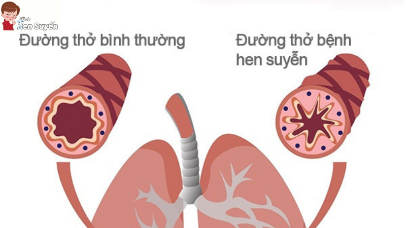 bệnh suyễn là gì